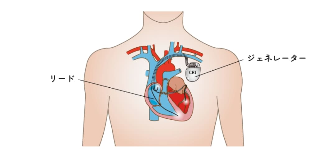 心臓再同期療法(CRT)