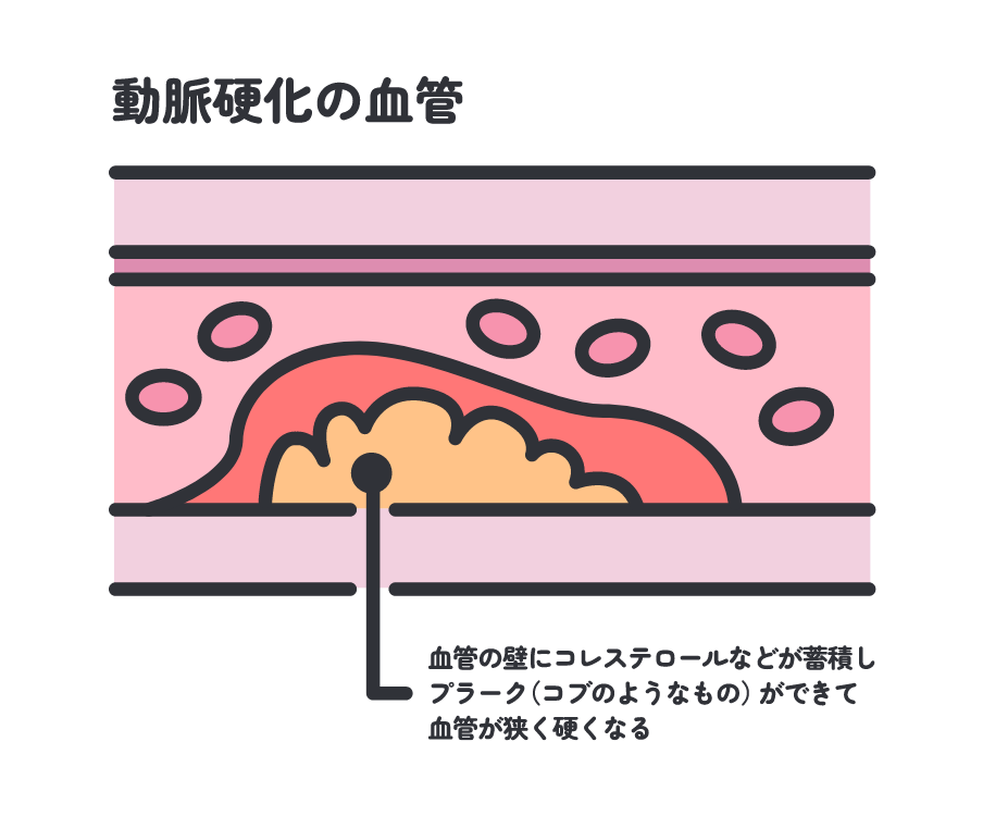 動脈硬化とは