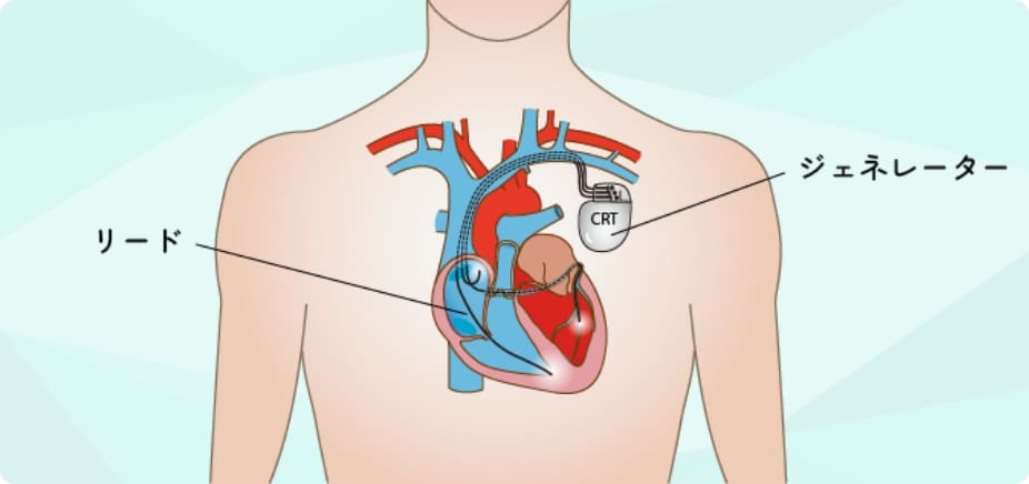 心臓再同期療法(CRT)